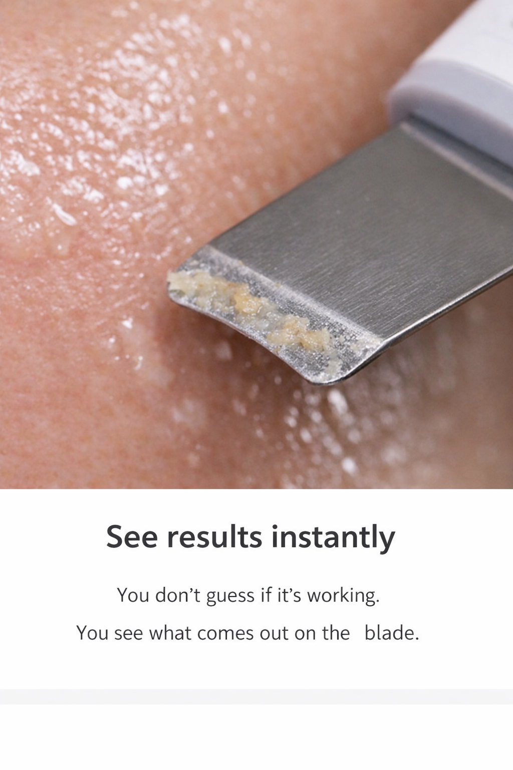 Etalis Ultrasonic Blackhead & Pore Cleansing Tool